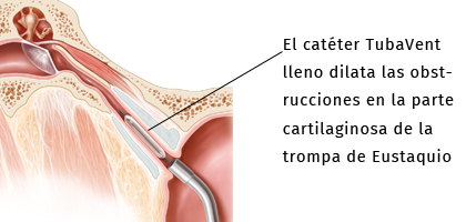 TabaVent lleno dilata