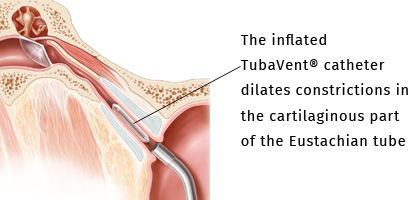 inflated TubaVent catheter