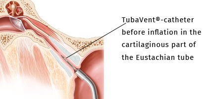 TubaVent-catheter before inflation