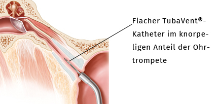 Flacher TubaVent-Katheter
