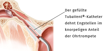 Gefüllter TubaVent-Katheter